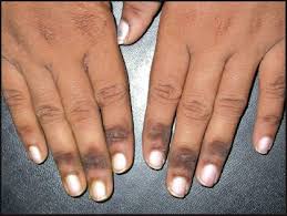 Acral Acanthosis Nigricans