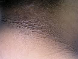 Acral Acanthosis Nigricans