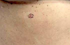Acantholytic Acanthoma