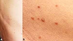 Acantholytic Acanthoma