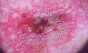 Acantholytic Acanthoma