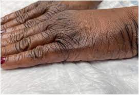 Acquired Hyperkeratosis