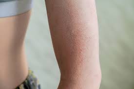 Acquired Hyperkeratosis