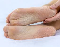 Acquired Hyperkeratosis