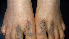 Acral Acanthosis Nigricans