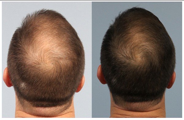 Before and after comparison of PRP treatment for hair loss