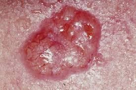 Aberrant Basal Cell Carcinoma