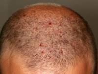 Acne Necrotica