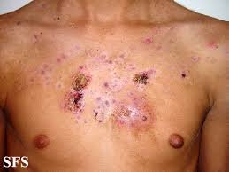 Acne Necrotica