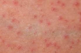 Acneiform Dermatitis