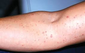 Acneiform Dermatitis