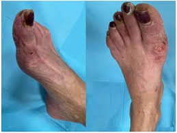 Acral Dry Gangrene