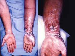 Acral Dry Gangrene