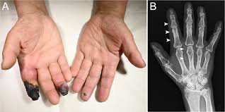 Acral Dry Gangrene