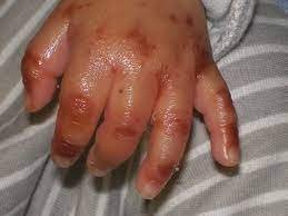 Acrodermatitis Enteropathica