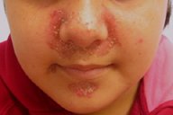 Acrodermatitis Enteropathica