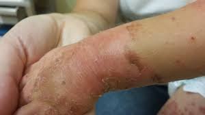 Acrodermatitis Enteropathica